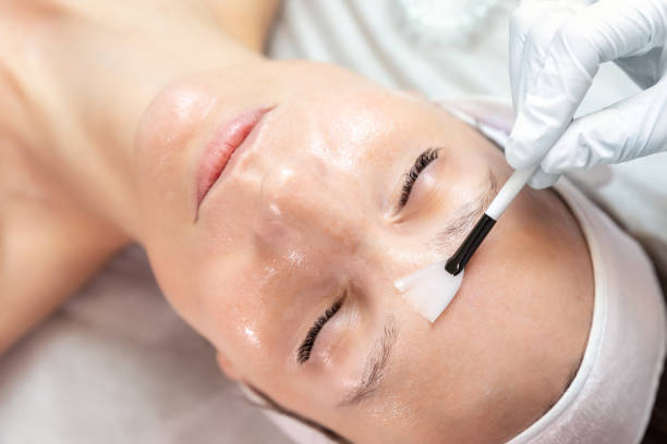 Chemical peels